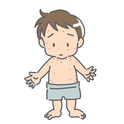 麻疹に患っている子どものイラスト